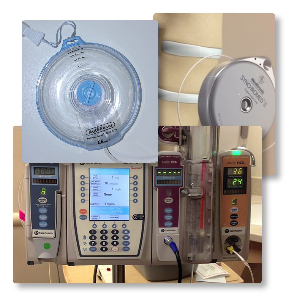 پمپ درد PCA و مدیریت درد پس از جراحی با اختیار بیمار و تکنولوژی پیشرفته کنترل درد Patient-Controlled Analgesia که به بیماران اجازه می‌دهد دوران نقاهت پس از سزارین، جراحی‌های ارتوپدی و عمومی را بدون درد و استرس سپری کنند. بررسی انواع پمپ‌های مکانیکی الاستومریک و الکترونیکی.